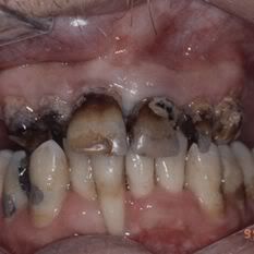 meth mouth Pictures, Images and Photos