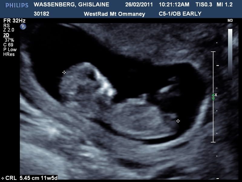 3d ultrasound pictures at 20 weeks. I am 21 +1 weeks and had a 3d