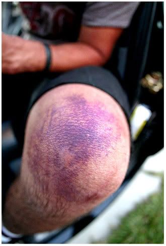 Bruise Knee
