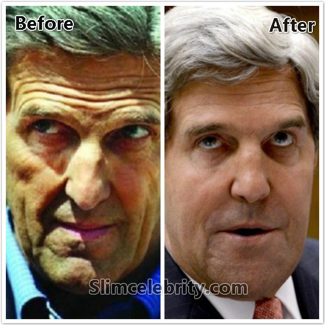  photo John-Kerry-Plastic-Surgery-Before-and-After-Photos-Botox-Face-Lift-Facial-fillers-Brow-Lift-and-Nose-job-5_zps1023c6eb.jpg