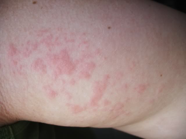 rashes on inside of elbow #11